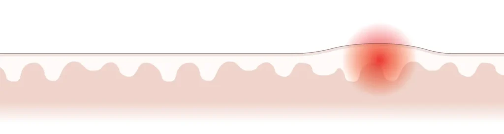 Inflamed skin in atopic dermatitis